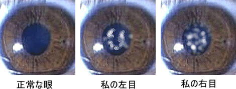 白内障のイメージ